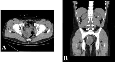 Case report: An unusual presentation of intra-abdominal desmoplastic small round cell tumor